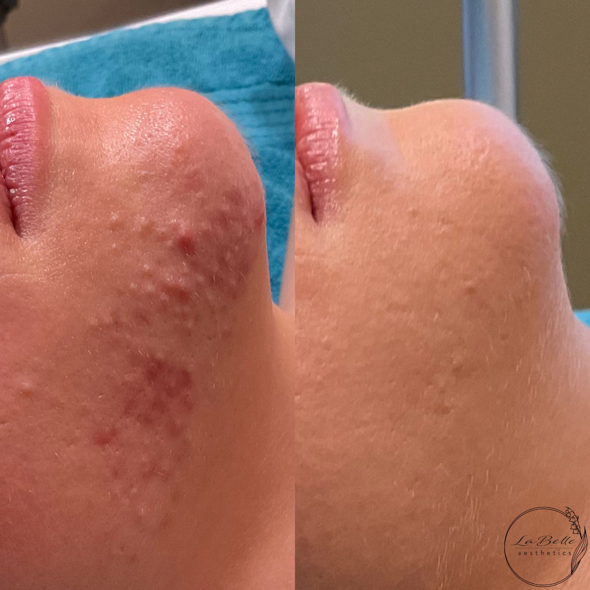 Acne Clearance