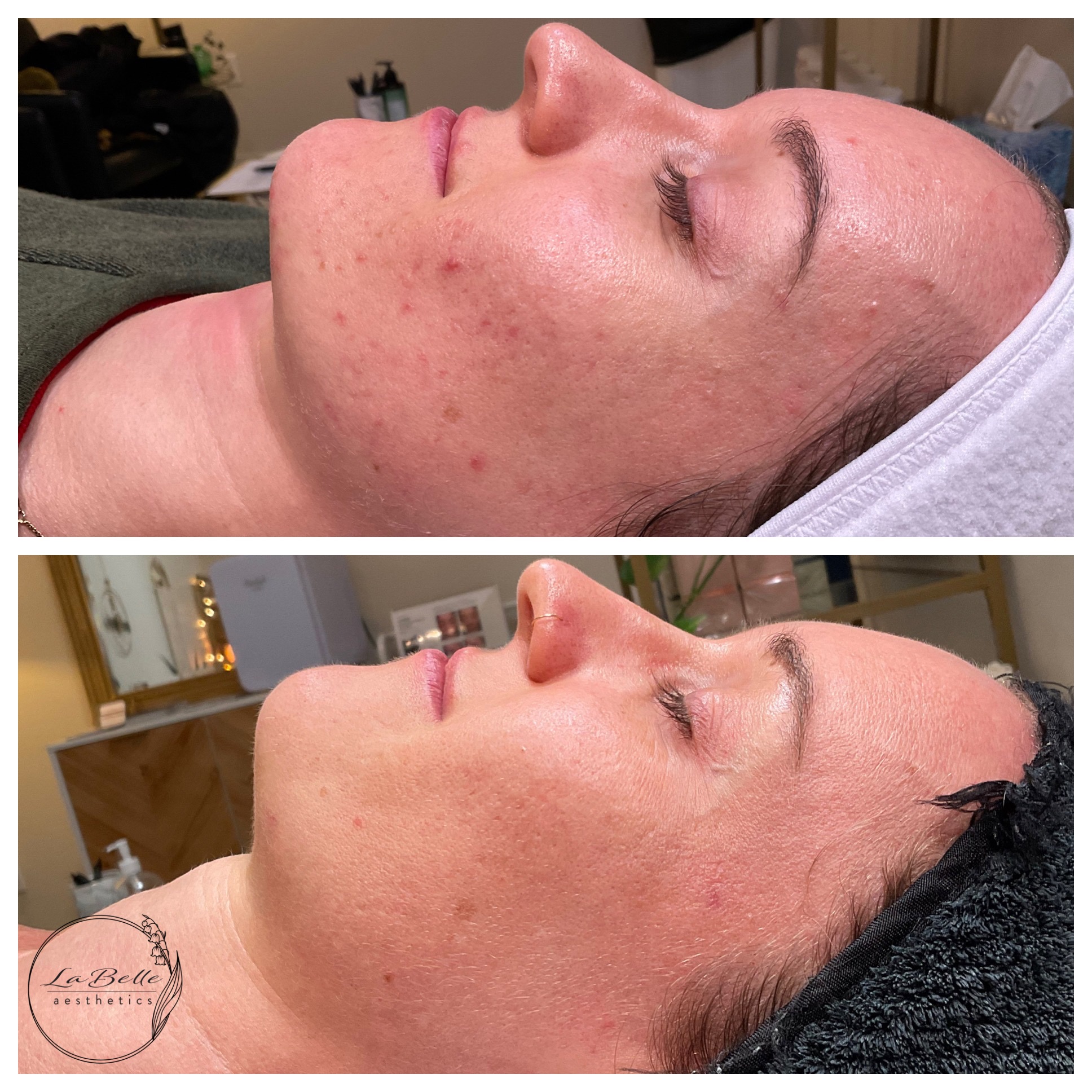 Acne Transformation