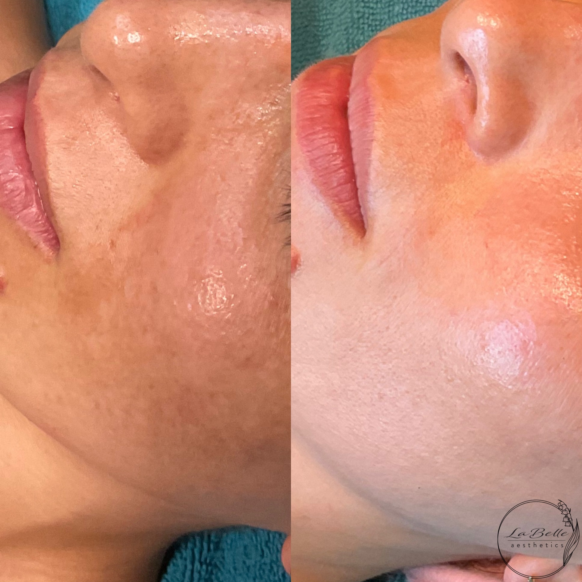 Melasma Improvement