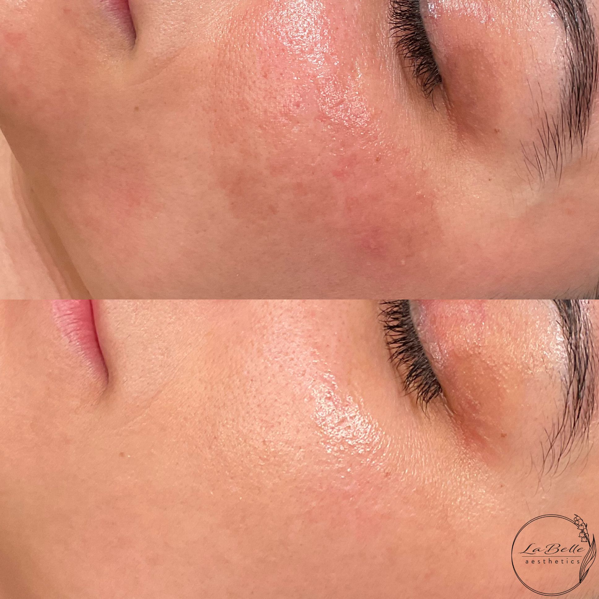 Scarring & Pigmentation
