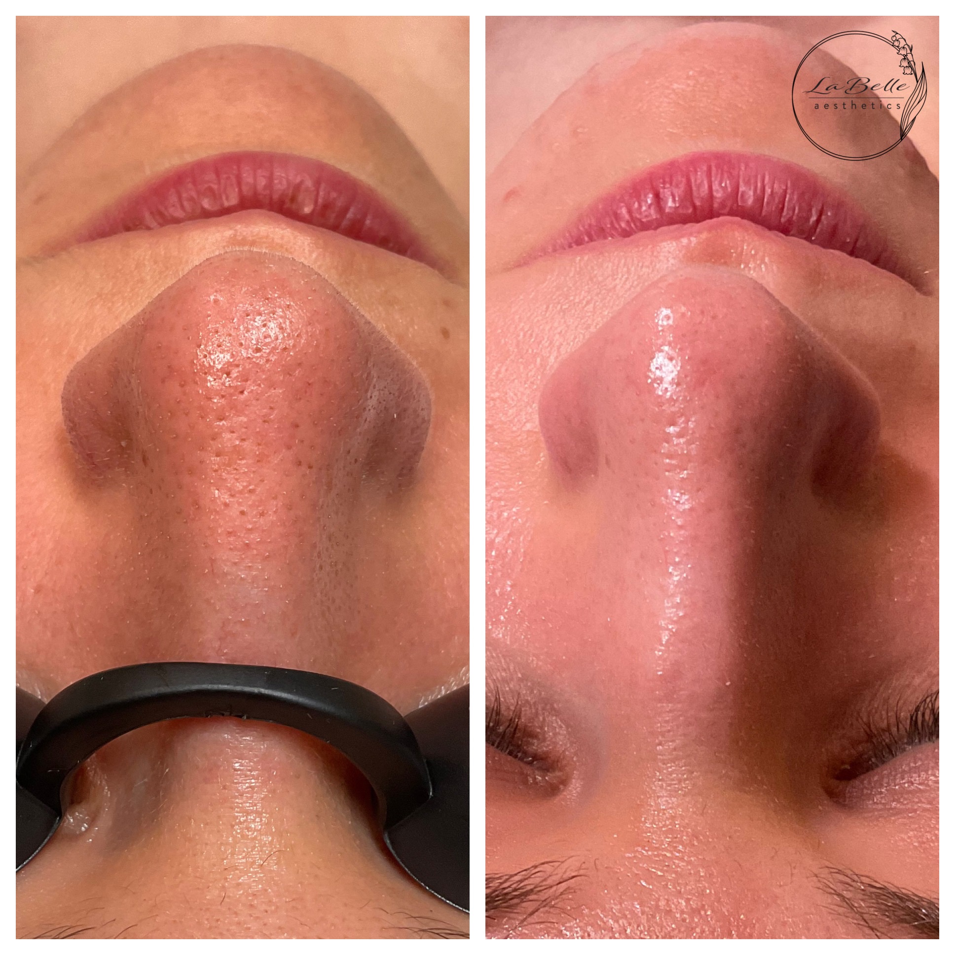 Pore Refinement