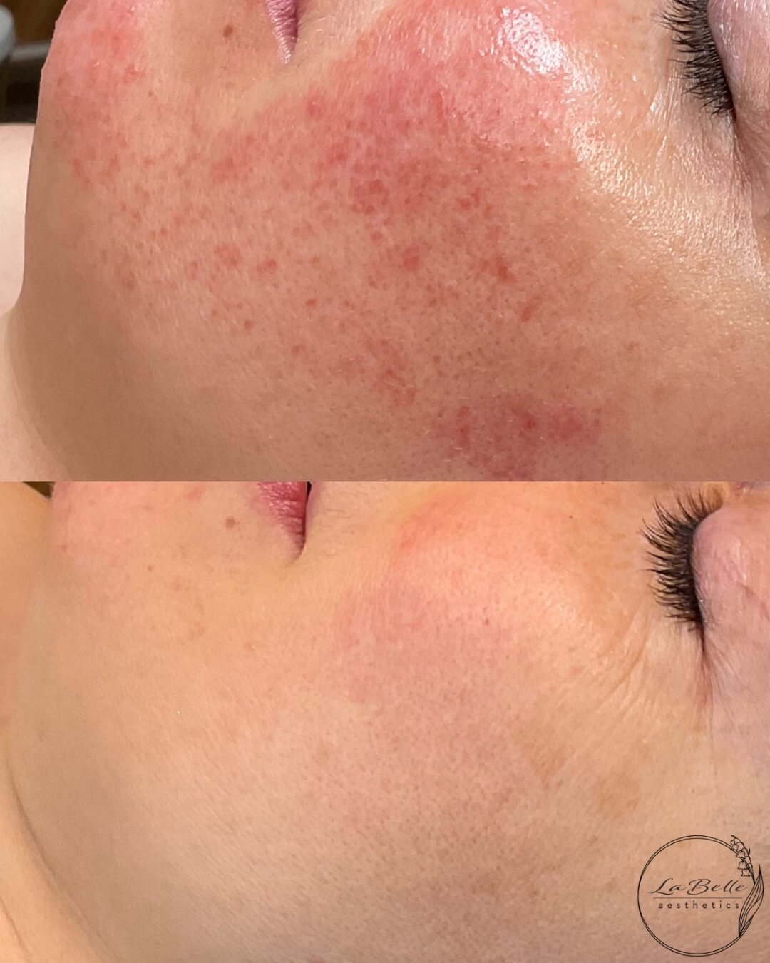 Rosacea Transformation with Custom Facials