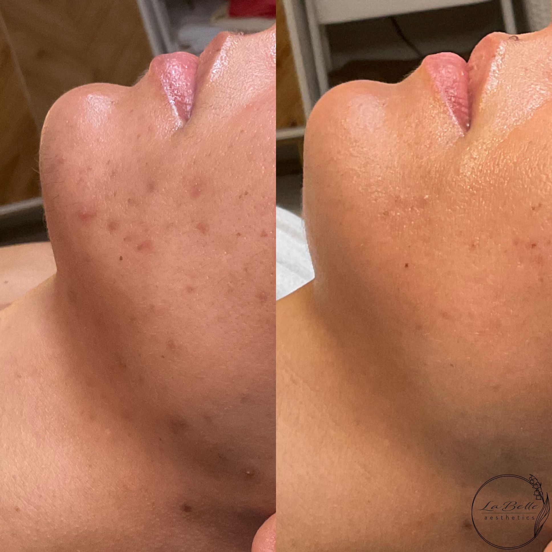 Acne and PIH Transformation